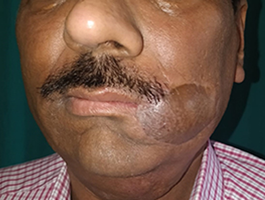 Cheek Reconstruction Best Cosmetic and Plastic Surgeon in Meerut