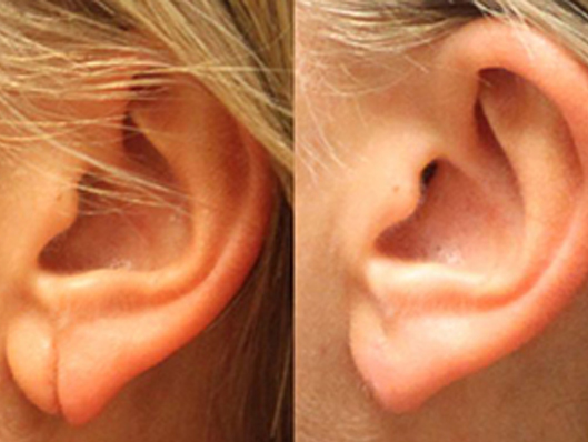 Ear Repair Surgery Best Cosmetic and Plastic Surgeon in Meerut