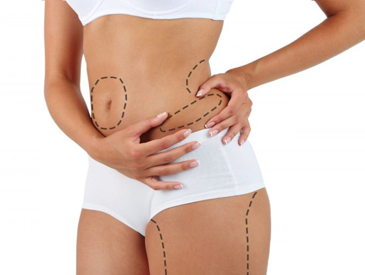 Liposuction Best Cosmetic and Plastic Surgeon in Meerut