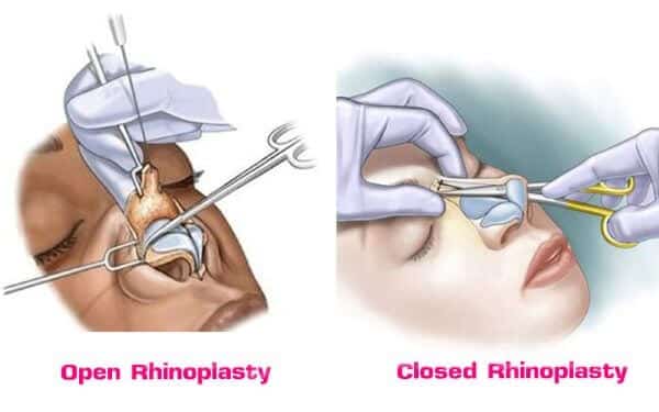 Rhinoplasty Procedure