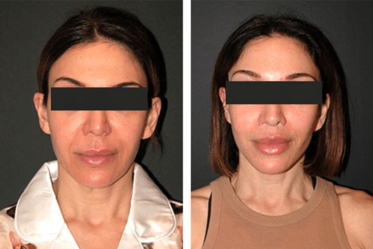 facelift surgery