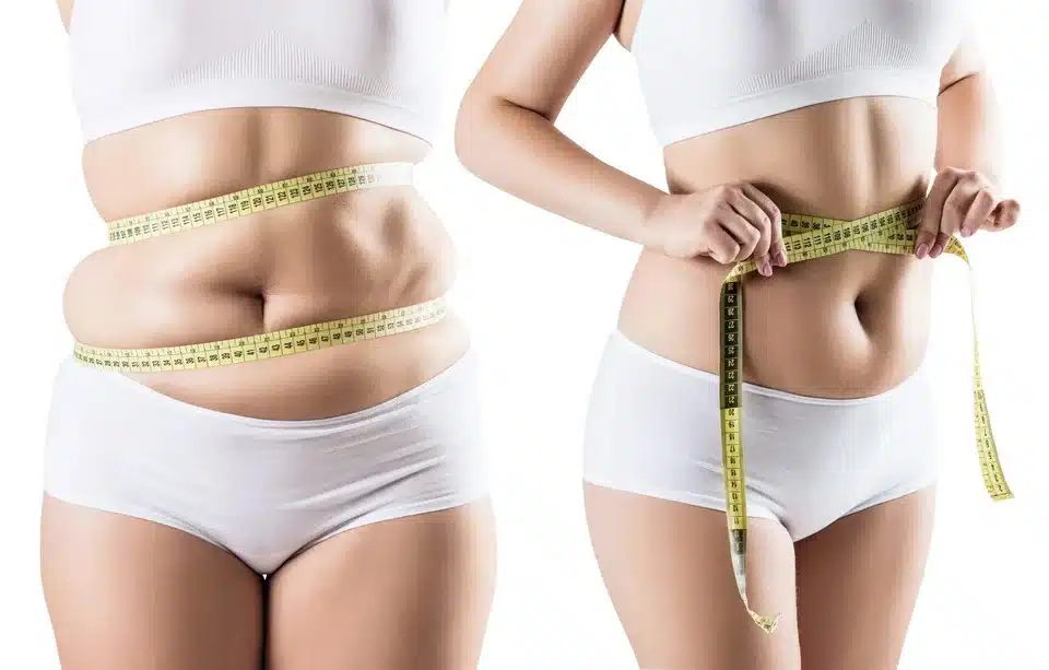 Liposuction vs. Non-Surgical Fat Reduction