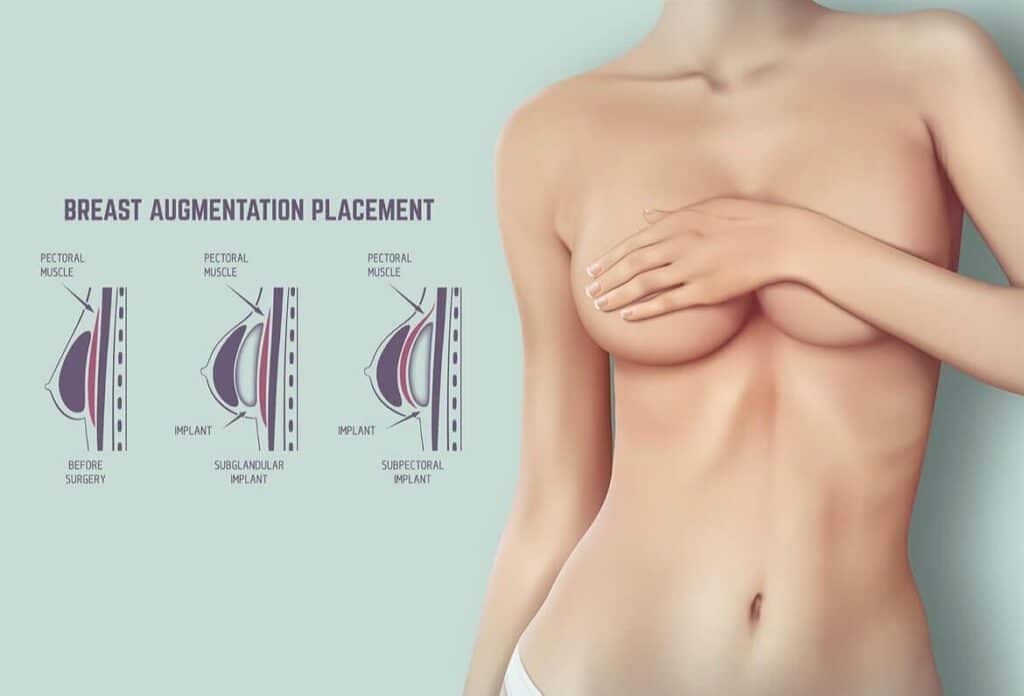 Breast Augmentation Surgery