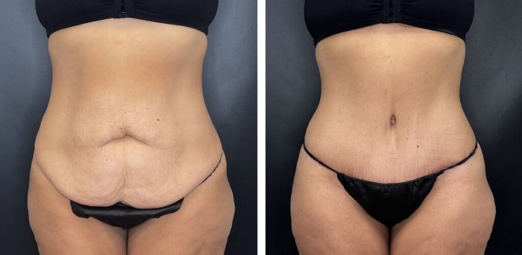 Tummy Tuck