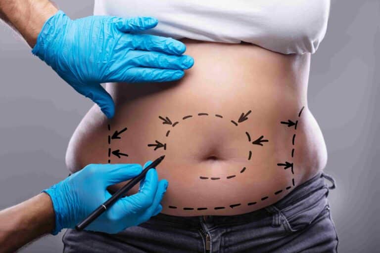 Tummy Tuck