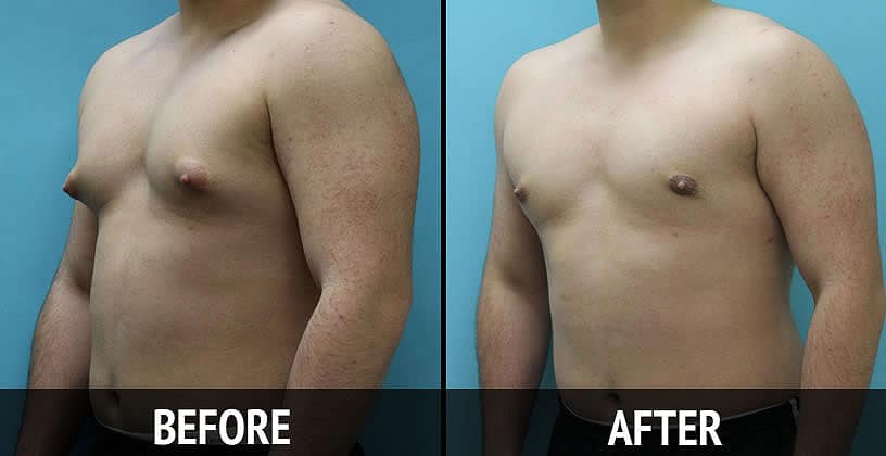 Gynecomastia Treatment