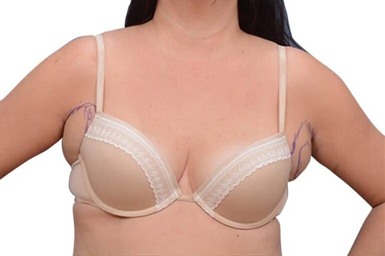 Axillary Breast Surgery