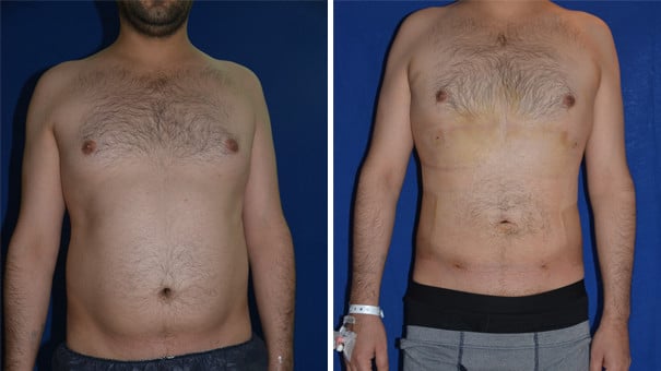 Liposuction for Men