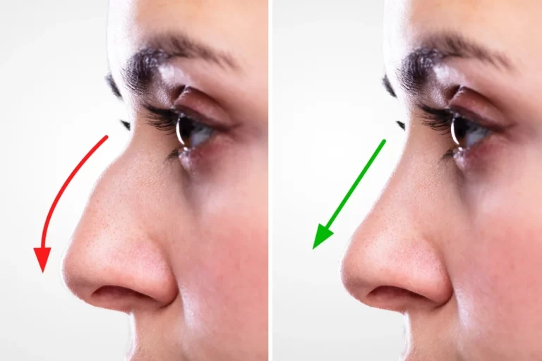 Nose Reshaping